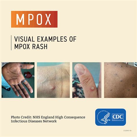 protacio health photos|One Extraordinary Photo: A picture captures the mpox health .